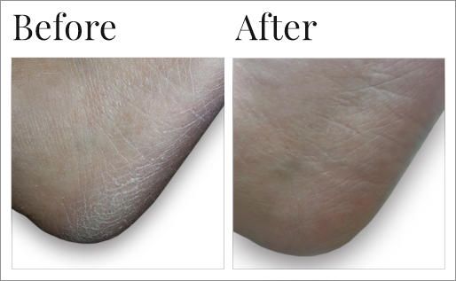 Before and After Dr. Canuso daily exfoliating cleanser