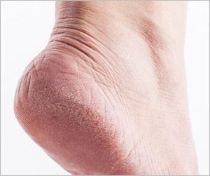 Dry Cracked Heels Dr Canuso Skincare for Feet